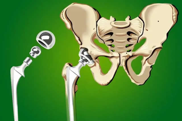 protesis de cadera